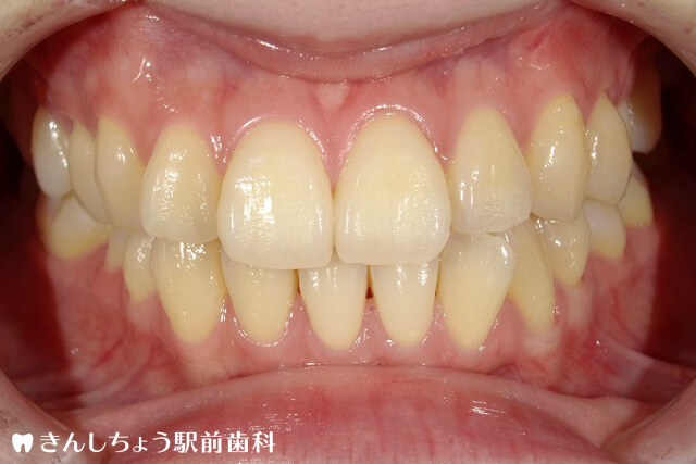 症例写真 Before